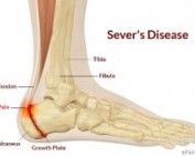 severs disease