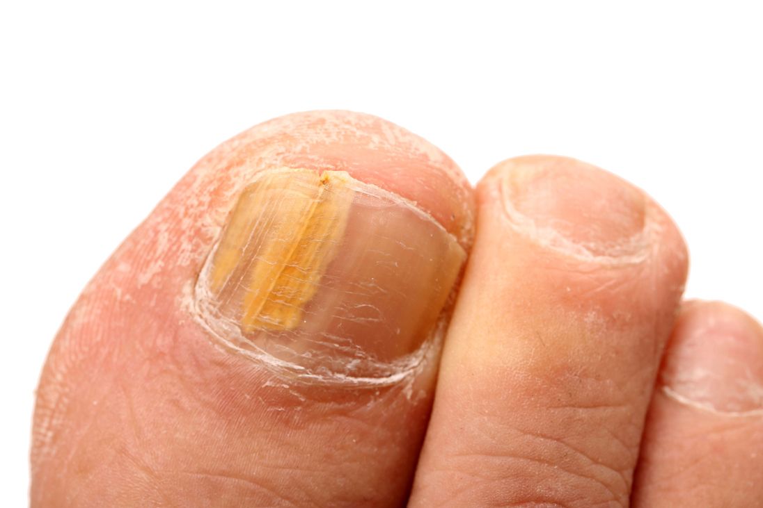 Nail Fungus Treatment Melbourne Podiatrists & Orthotics