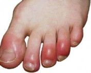 Chilblains...And How To Avoid Them This Winter
