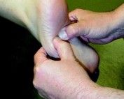 Cuboid Syndrome - A Cause Of Lateral Foot Pain