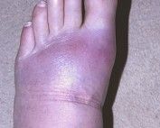 Gout On The Rise