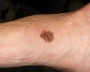 Melanoma And Feet