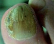 The Next Big Thing In Nail Fungus Treatment