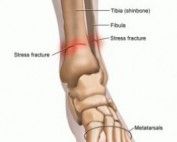 metatarsal stress fracture