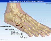 Jones fracture foot injury