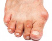 Bunions & Orthotics Melbourne