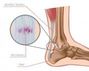 Achilles tendinopathy Melbourne Podiatrist