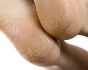 cracked heels Melbourne podiatrist