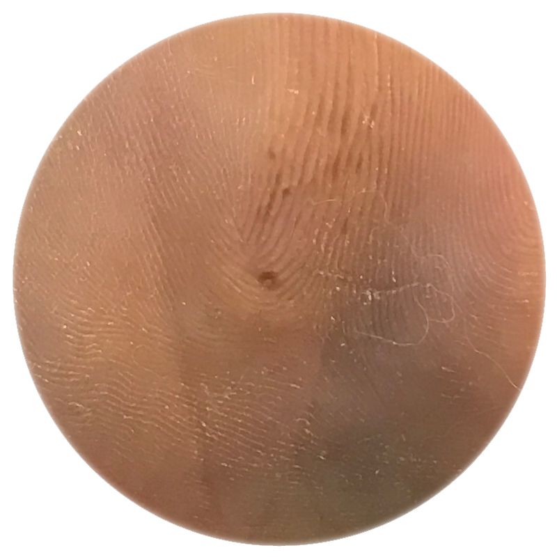 Corn_Medium Circle_MPAO Corn removal podiatrist Camberwell