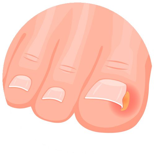 Ingrown toenail_Medium Circle_MPAO Ingrown toenail treatment Camberwell