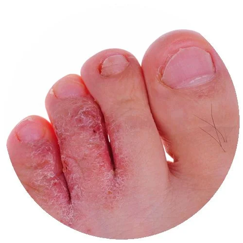 Tinea_Medium Circle_MPAO Tinea athlete