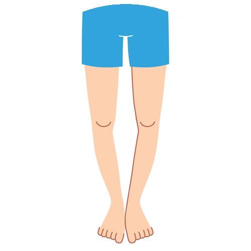 Bow Legs | Children's Podiatrist | Melbourne Podiatrists & Orthotics