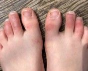Covid toes podiatrist Melbourne