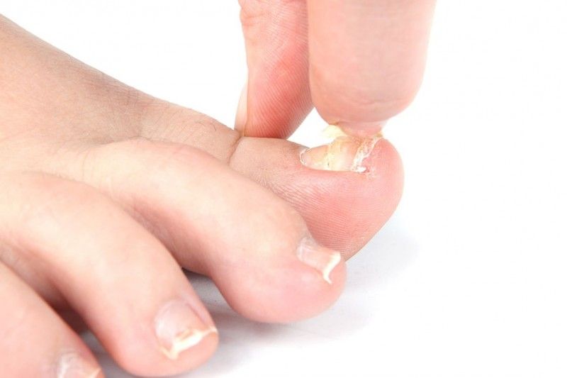 Nail Fungus Treatment Melbourne Podiatrists & Orthotics