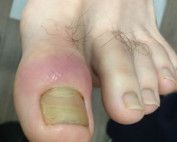 Retronychia podiatrist Melbourne