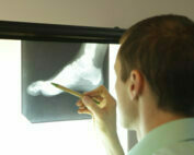 Turf toe Melbourne podiatrist