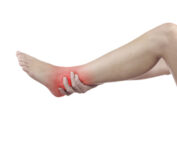Retrocalcaneal bursitis Melbourne Podiatrist