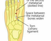 Lisfranc foot injury podiatrist Melbourne