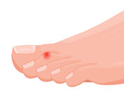 hammertoe treatment Melbourne podiatrist