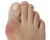 Gout Melbourne Podiatrist