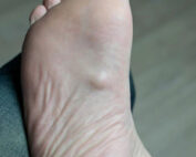 Plantar Fibroma Melbourne podiatrist