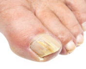 Fungal toenail treatment Melbourne podiatrist
