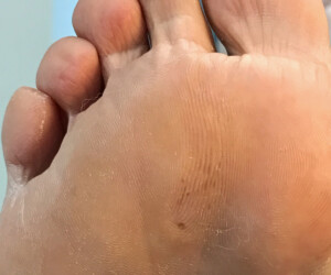 Corn treatment Melbourne Podiatrist