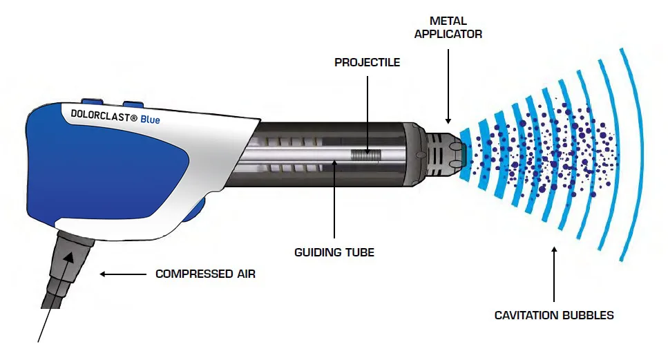 Shockwave Therapy How it works Shockwave therapy Camberwell