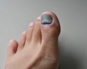 Black toenail treatment Melbourne Podiatrist