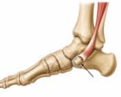 Accessory Navicular Bone_MPAO